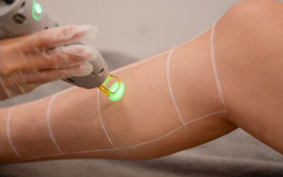 5 Myths About Laser Treatments — Busted!