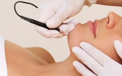 Elektrisch epileren aan het gezicht