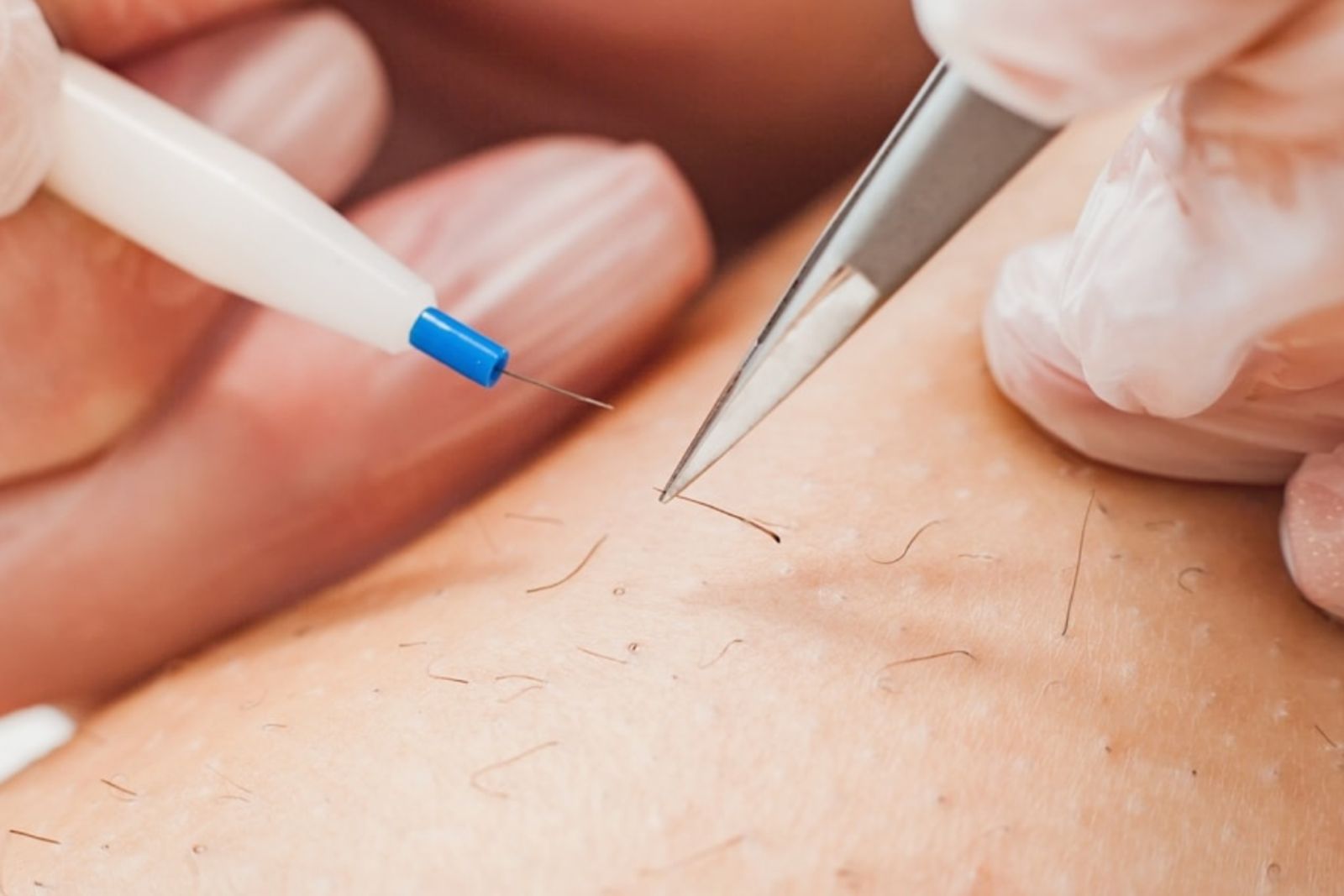 Elektrolyse behandeling