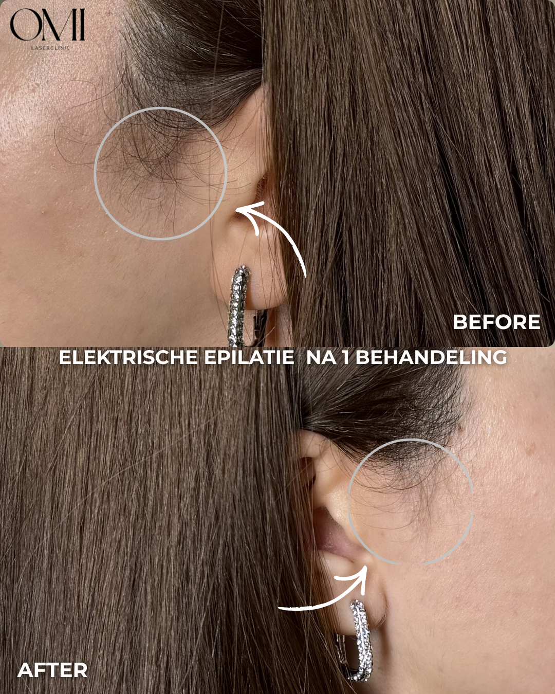 Elektrolyse behandeling